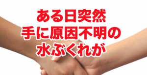 寝不足・ストレスが汗疱の原因に？ある日突然手に水泡（水膨れ）が