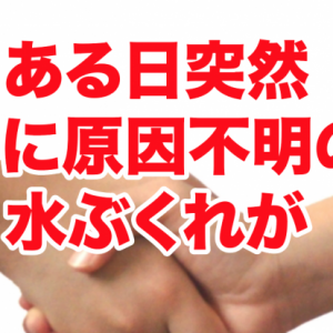 寝不足・ストレスが汗疱の原因に？ある日突然手に水泡（水膨れ）が