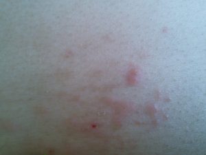 二の腕のブツブツは毛孔性苔癬(もうこうせいたいせん)が原因？